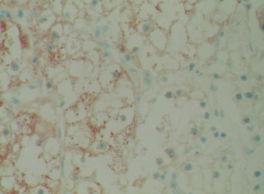 L-PK_staining_in_RCCs