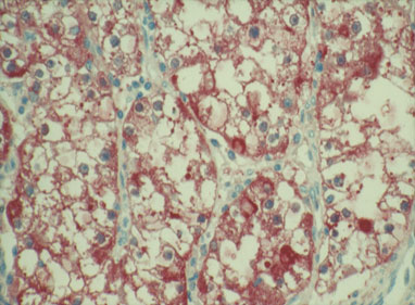 M2-PK_staining_in_RCCs02